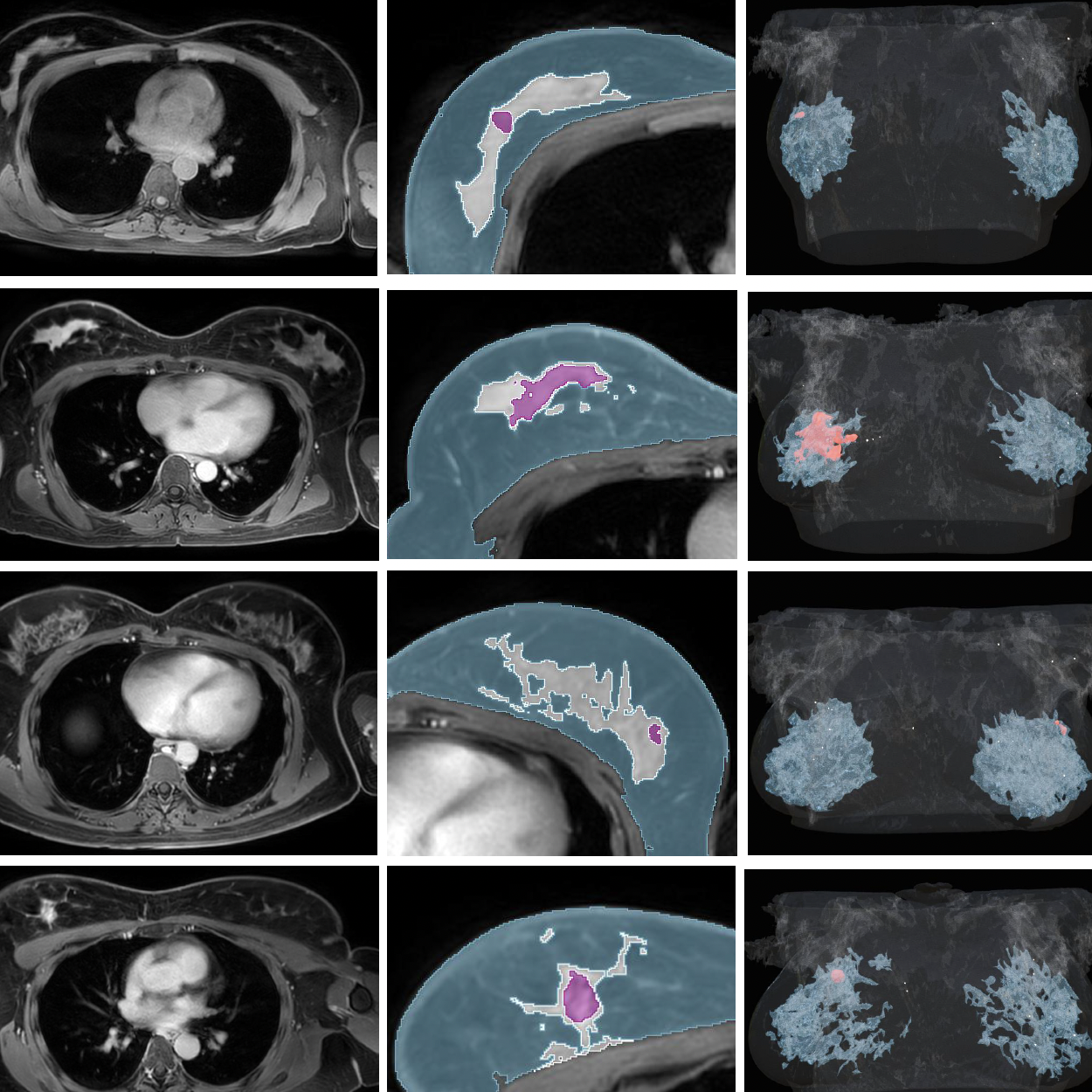 Improving breast surgery accuracy through patient-specific digital twins