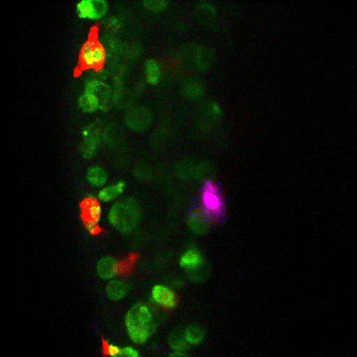 2-Human tumor cells (green) being cleared by macrophages (red) and neutrophils (pink) 