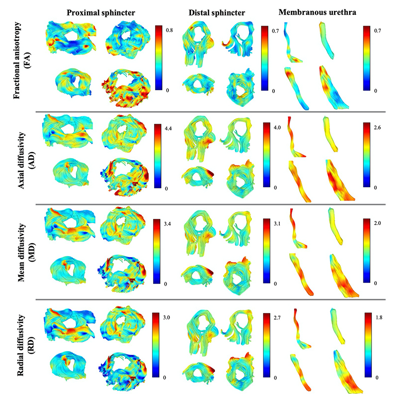 Imaging prior to surgery may reduce the risk of incontinence after prostate cancer removal