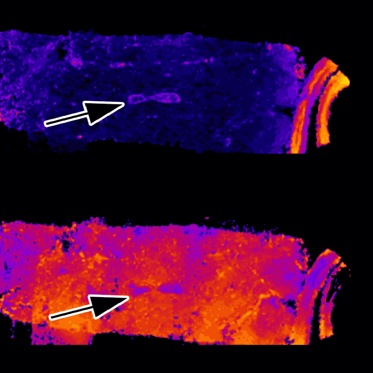 For the first time, researchers detect pre-malignant pancreatic lesions with magnetic resonance imaging