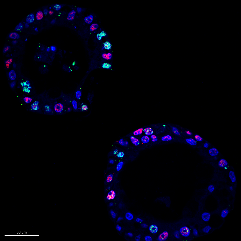 The secret DNA circles fueling Pancreatic Cancer’s aggression