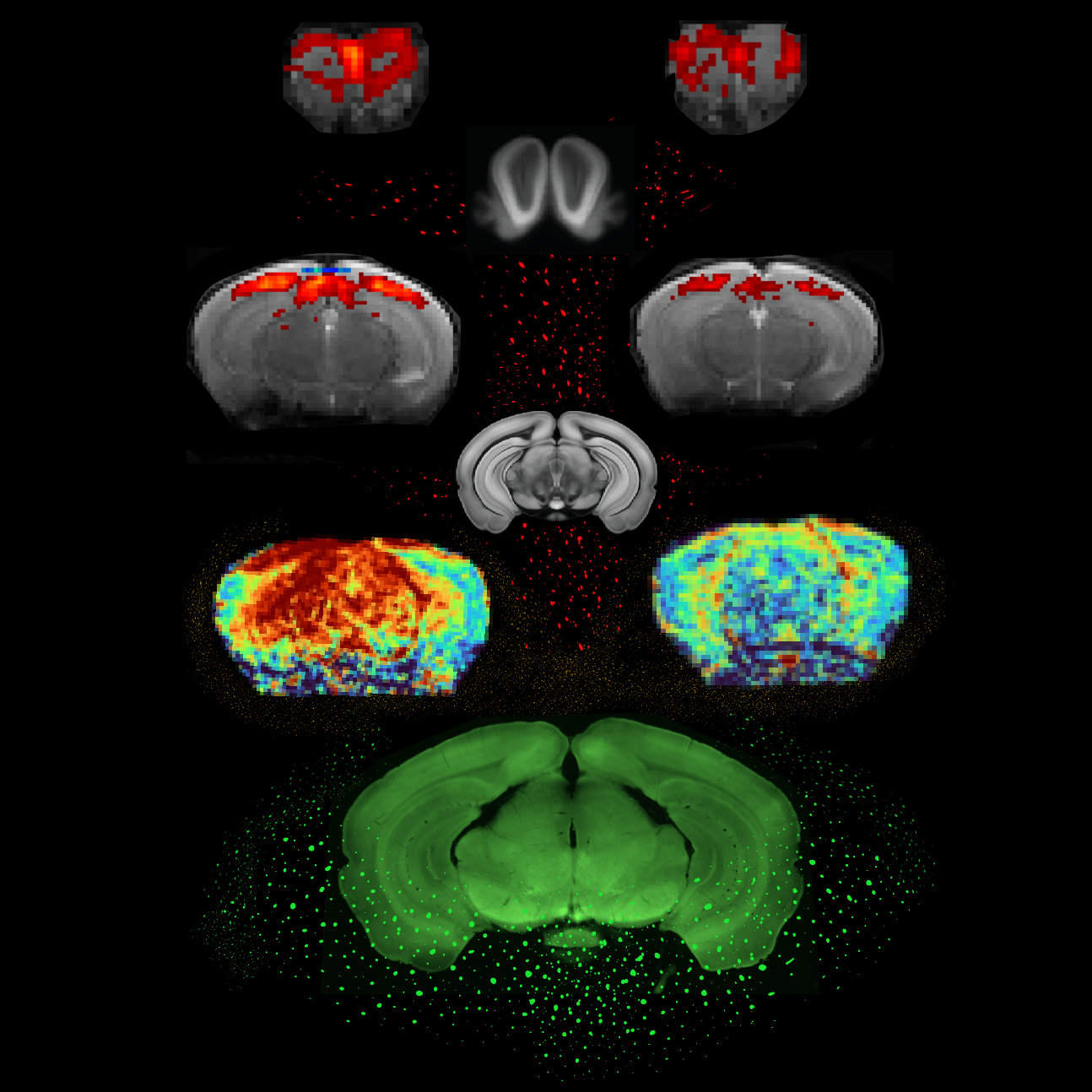The hope for detecting Parkinson’s disease much earlier with a simple brain scan