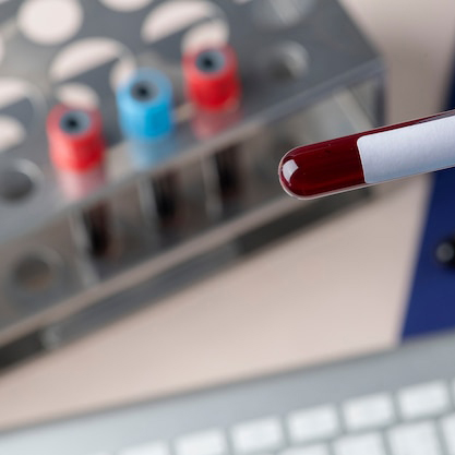 The search for a “liquid biopsy” to diagnose and monitor multiple myeloma is starting to pay off