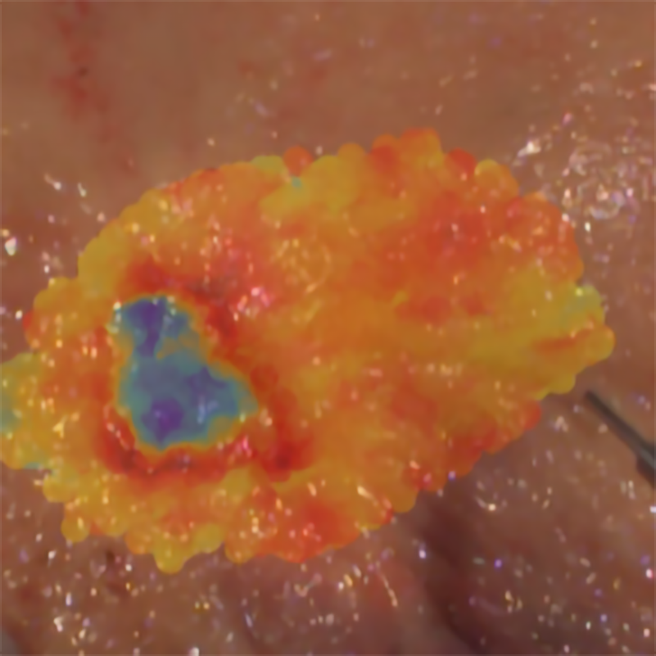 “Painting” tissues with light to detect cancerous tumours and their margins Champalimaud