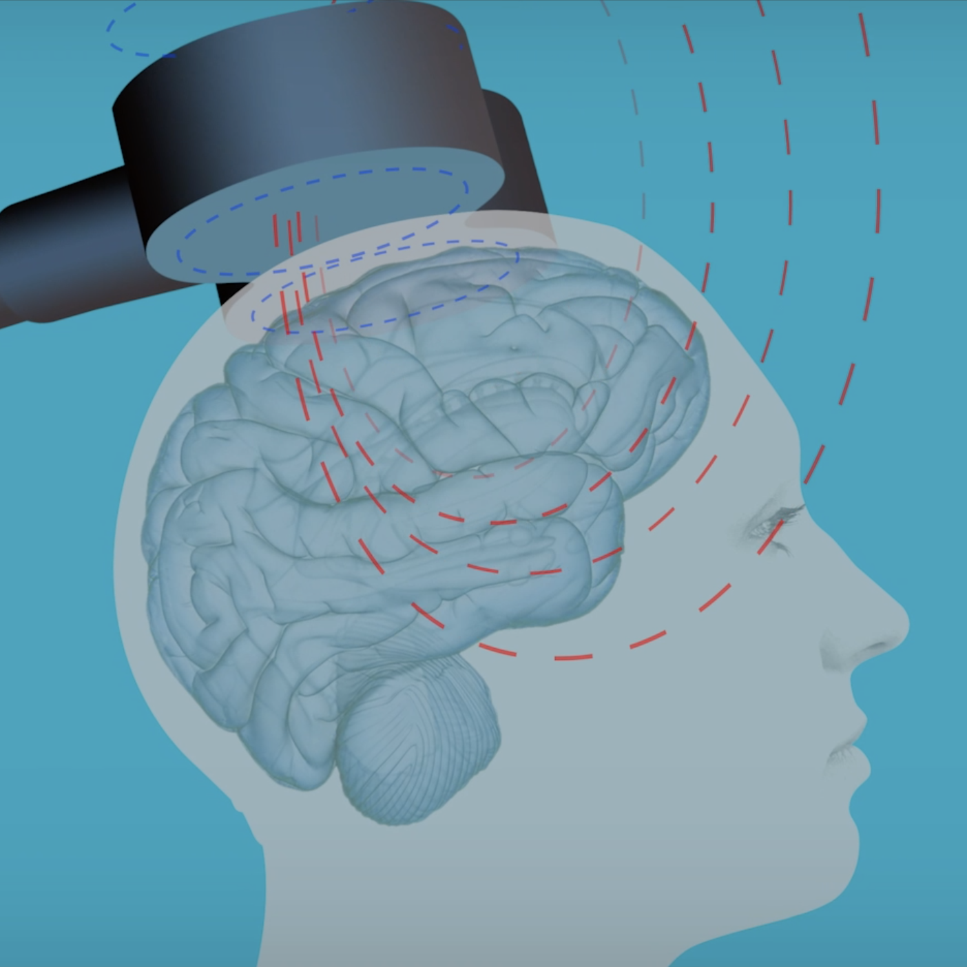 Devagar se vai ao longe: porque é que a estimulação cerebral não deve ser negligenciada como um tratamento antidepressivo nas pessoas mais velhas