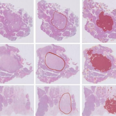 Spatial Tumor Pathology